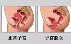 私密整形预防子宫脱垂,私密整形术后预防子宫脱垂的护理指南