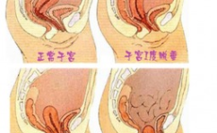 私密整形预防子宫脱垂,私密整形术后预防子宫脱垂的护理指南