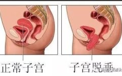 私密整形预防子宫脱垂,私密整形术后预防子宫脱垂的护理指南